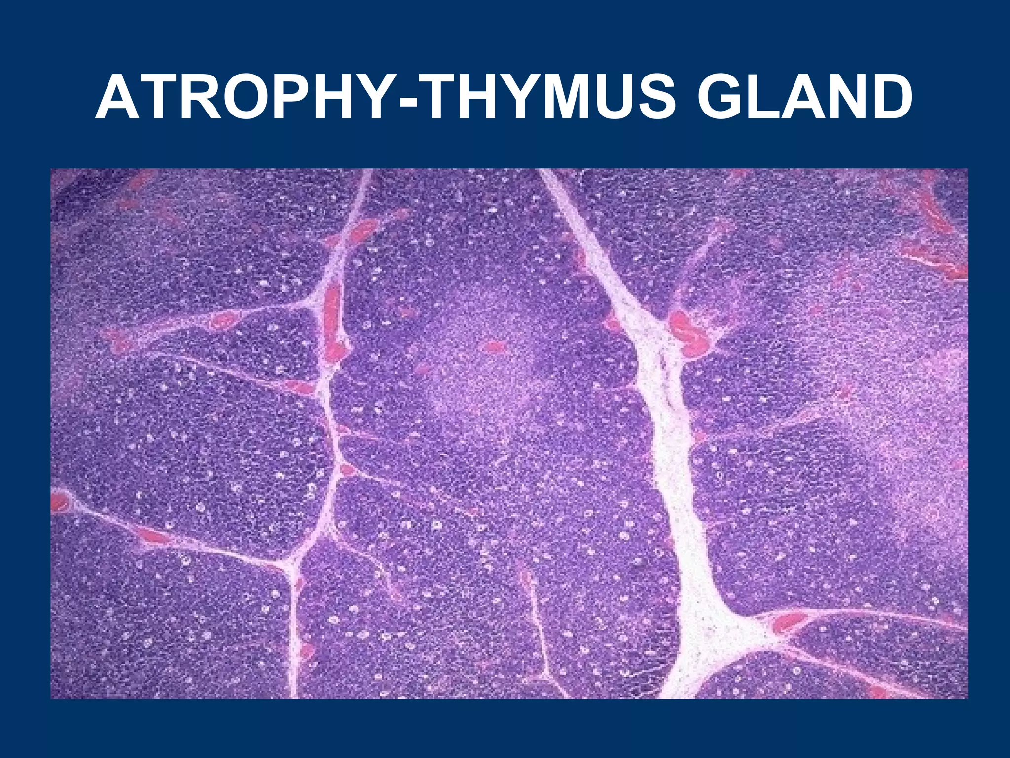 ATROPHY-THYMUS GLAND
 