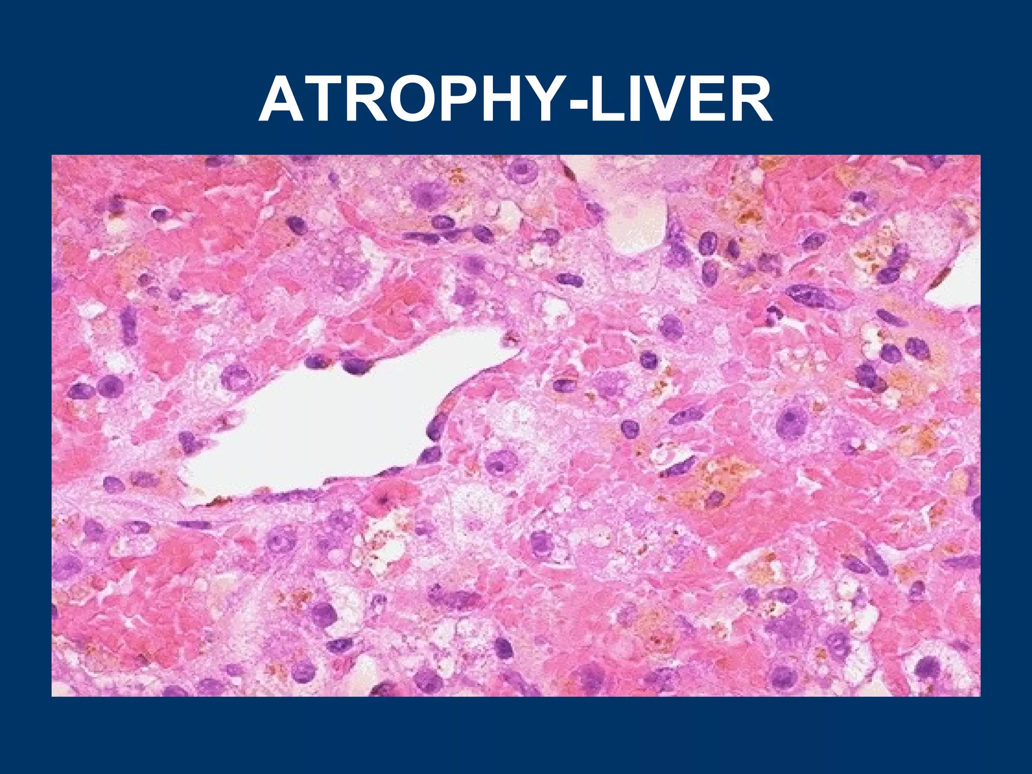 ATROPHY-LIVER
 