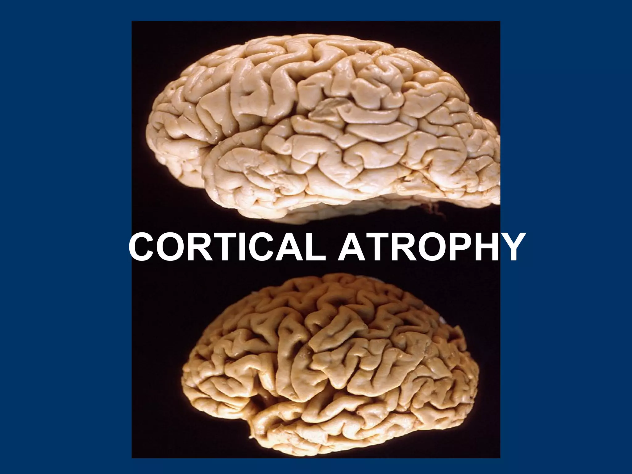 CORTICAL ATROPHY
 