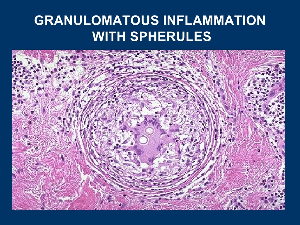 General pathology lecture 5 inflammation & repair