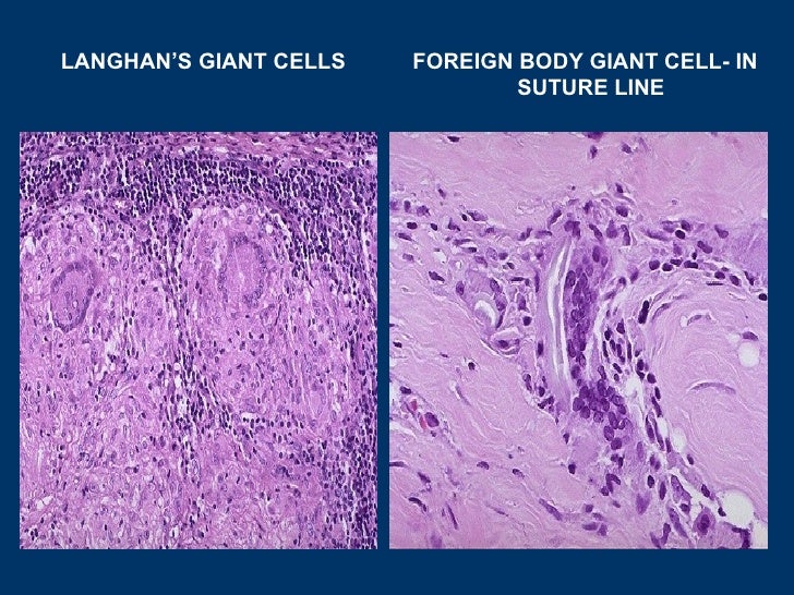 General pathology lecture 5 inflammation & repair