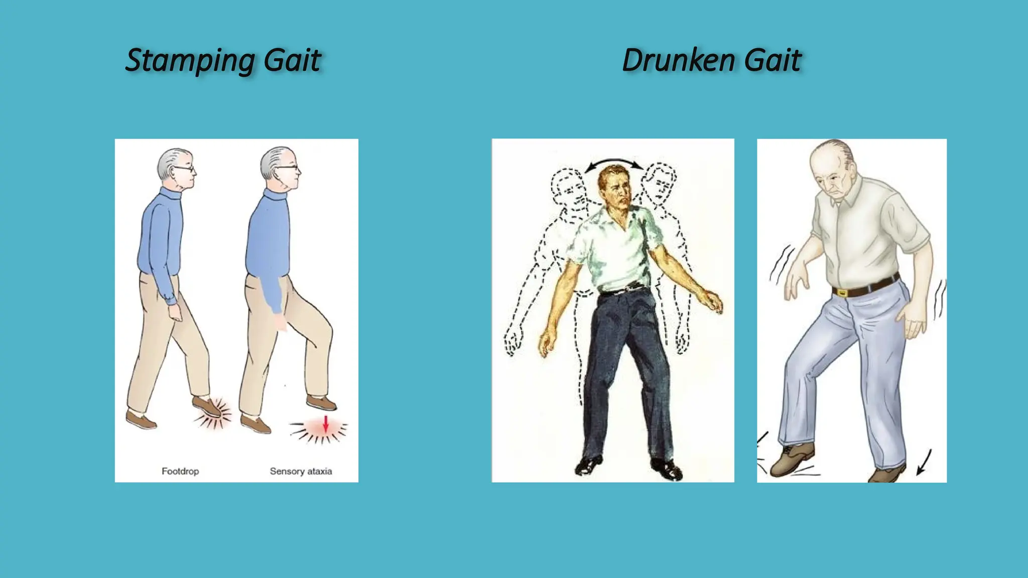 Stamping Gait Drunken Gait
 