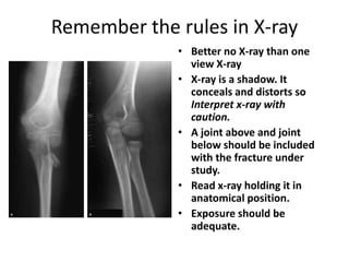 Remember the rules in X-ray<br />Better no X-ray than one view X-ray<br />X-ray is a shadow. It  conceals and distorts so ...