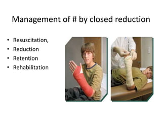 Management of # by closed reduction<br />Resuscitation, <br />Reduction <br />Retention<br />Rehabilitation<br />