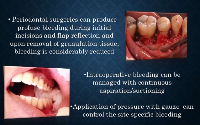general principles of periodontal surgery periodontal surgery