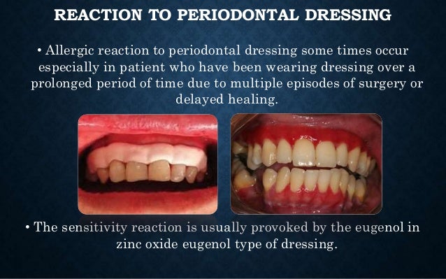 periodontal dressing