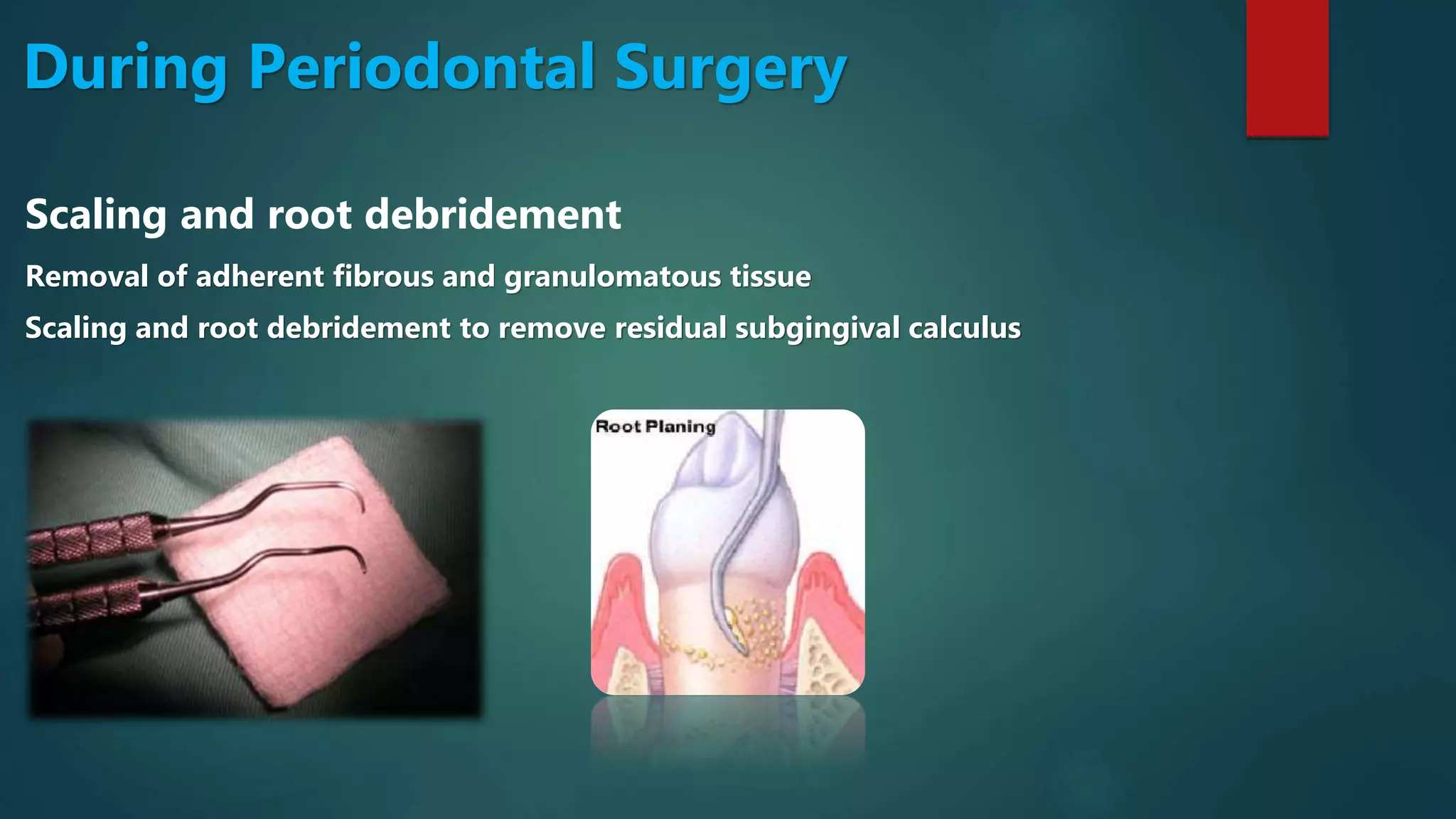 During Periodontal Surgery
Scaling and root debridement
Removal of adherent fibrous and granulomatous tissue
Scaling and root debridement to remove residual subgingival calculus
 