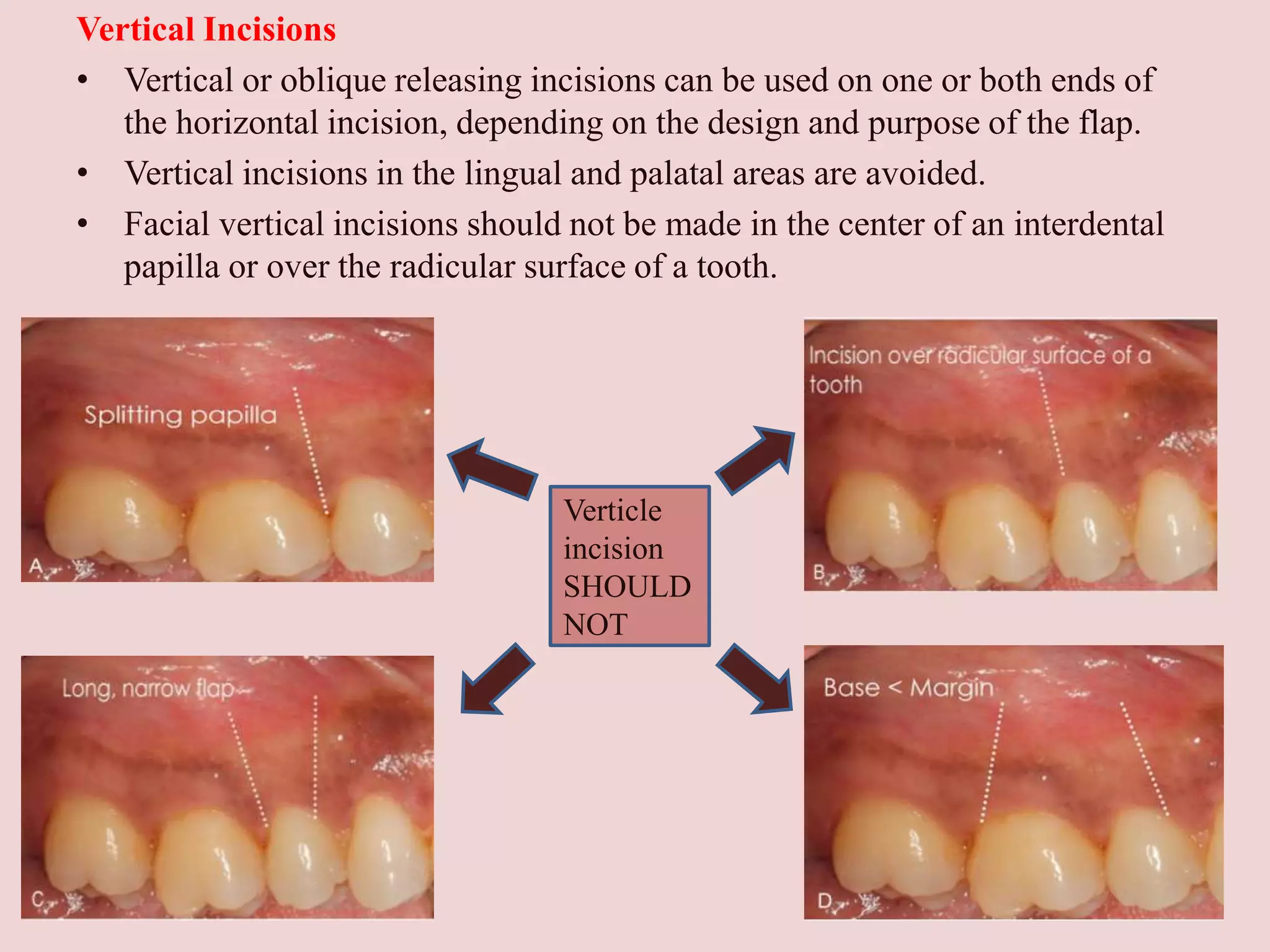 General principles of periodontal surgery | PPTX