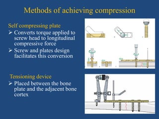 Plating principles in Orthopaedics | PPTX