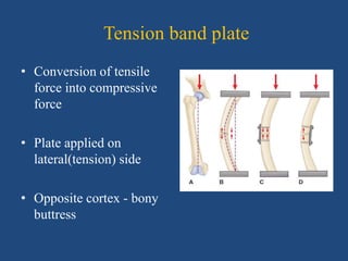 Plating principles in Orthopaedics | PPTX