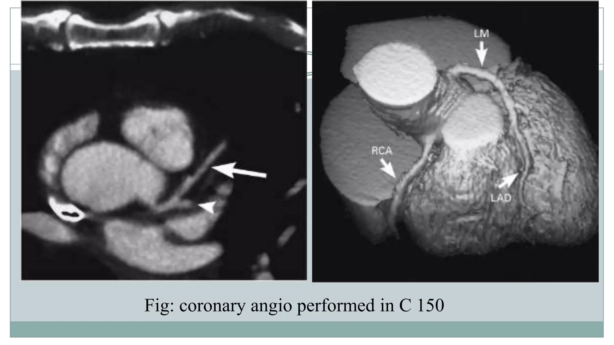 Generations and advancement of CT | PPTX