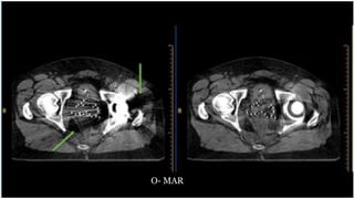 Generations and advancement of CT | PPTX