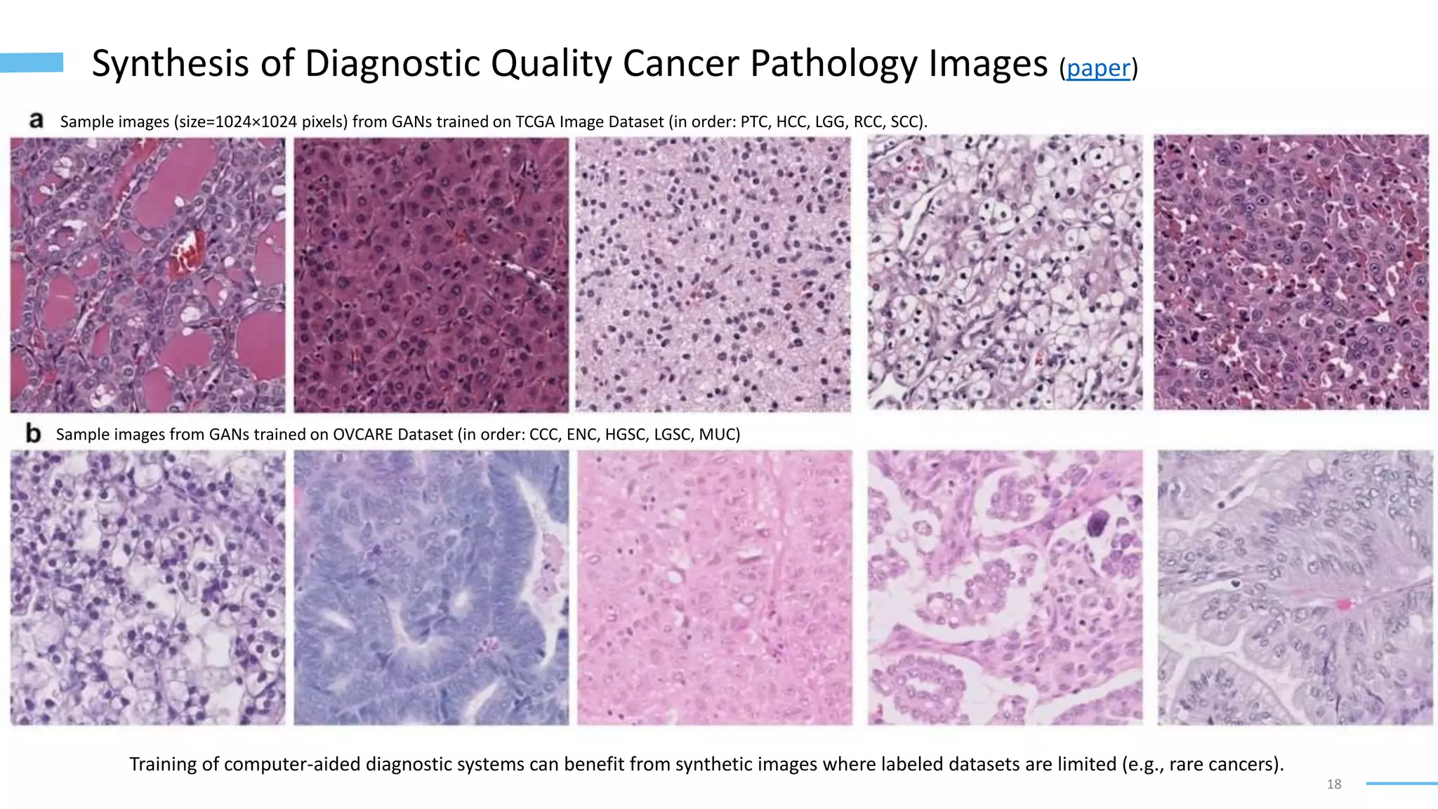 18
Synthesis of Diagnostic Quality Cancer Pathology Images (paper)
Sample images (size=1024×1024 pixels) from GANs trained on TCGA Image Dataset (in order: PTC, HCC, LGG, RCC, SCC).
Sample images from GANs trained on OVCARE Dataset (in order: CCC, ENC, HGSC, LGSC, MUC)
Training of computer-aided diagnostic systems can benefit from synthetic images where labeled datasets are limited (e.g., rare cancers).
 
