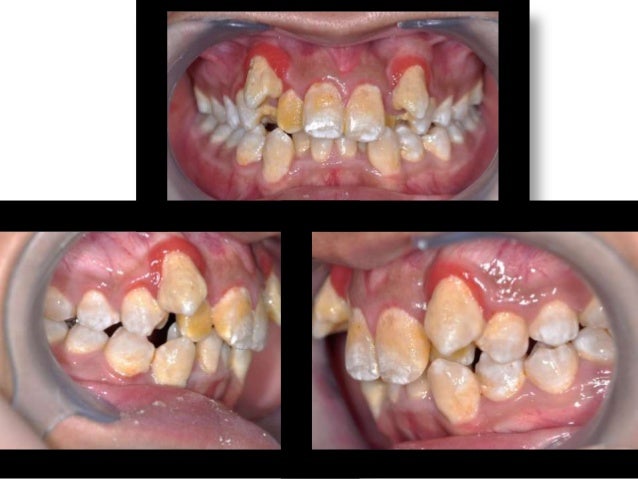 does invisalign work