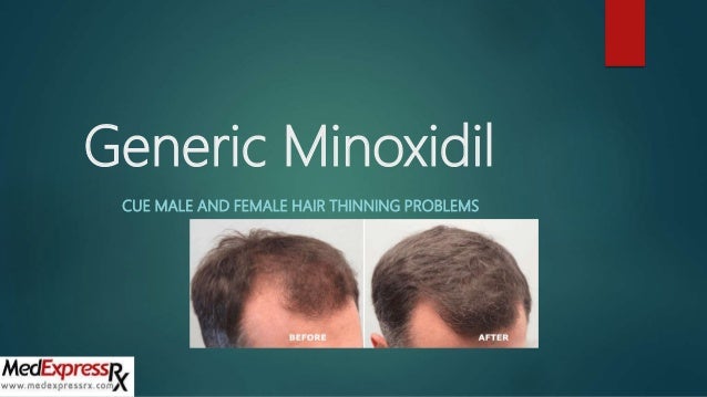 Generic Minoxidil Is Used To Treat Hair Thinning Problem