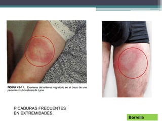 Borrelia
PICADURAS FRECUENTES
EN EXTREMIDADES.
 