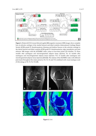 The Effect of Intra-articular Injection of Autologous Microfragmented Fat Tissue on Proteoglycan Synthesis in Patients with Knee Osteoarthritis