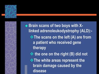  Brain scans of two boys with X-
linked adrenoleukodystrophy (ALD):-
The scans on the left (A) are from
a patient who received gene
therapy
 the one on the right (B) did not
The white areas represent the
brain damage caused by the
disease
 