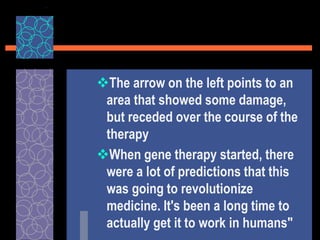 The arrow on the left points to an
area that showed some damage,
but receded over the course of the
therapy
When gene therapy started, there
were a lot of predictions that this
was going to revolutionize
medicine. It's been a long time to
actually get it to work in humans"
 