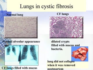 Lungs in cystic fibrosis
Normal lung CF lungs
dilated crypts
filled with mucus and
bacteria.
Normal alveolar appearance
CF lungs filled with mucus
lung did not collapse
when it was removed
postmortem
 