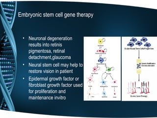 Embryonic stem cell gene therapy


  • Neuronal degeneration
    results into retinis
    pigmentosa, retinal
    detachment,glaucoma
  • Neural stem cell may help to
    restore vision in patient
  • Epidermal growth factor or
    fibroblast growth factor used
    for proliferation and
    maintenance invitro
 
