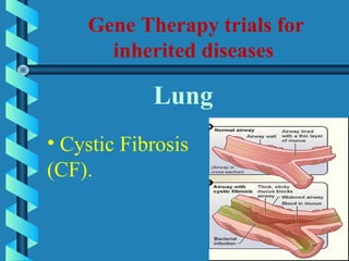 Gene Therapy trials for
inherited diseases
Lung
• Cystic Fibrosis
(CF).
 