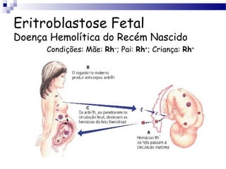 Eritroblastose Fetal
Doença Hemolítica do Recém Nascido
Condições: Mãe: Rh-
; Pai: Rh+
; Criança: Rh+
 