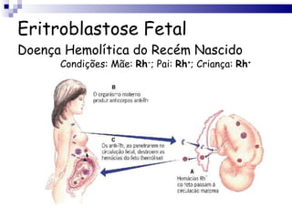 Eritroblastose Fetal Doença Hemolítica do Recém Nascido Condições: Mãe:  Rh - ; Pai:  Rh + ; Criança:  Rh + 