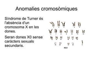 Anomalies cromosòmiques
Síndrome de Turner és
l'absència d'un
cromosoma X en les
dones.
Seran dones X0 sense
caràcters sexuals
secundaris.
 