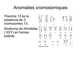 Anomalies cromosòmiques
Trisomia 13 és la
presència de 3
cromosomes 13.
Síndrome de Klinefelter
( XXY) en homes
estèrils.
 