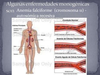Anemia falciforme (cromosoma 11) -
autosómica recesiva
 