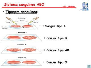 Sistema sanguíneo ABO
• Tipagem sanguínea:
Prof. Emanuel
Sangue tipo A
Sangue tipo B
Sangue tipo AB
Sangue tipo O
 