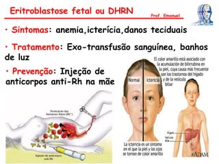 Eritroblastose fetal ou DHRN Prof. Emanuel
• Tratamento: Exo-transfusão sanguínea, banhos
de luz
• Sintomas: anemia,icterícia,danos teciduais
• Prevenção: Injeção de
anticorpos anti-Rh na mãe
 