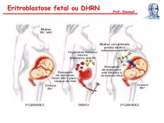 Eritroblastose fetal ou DHRN Prof. Emanuel
 