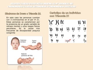 En este caso las personas cuentan
con 3 cromosomas en el par nº 21.
Estas personas se caracterizan por
la presencia de un grado variable de
retraso mental y unos rasgos físicos
peculiares.
Es
la
causa
más
frecuente de discapacidad psíquica
congénita

 