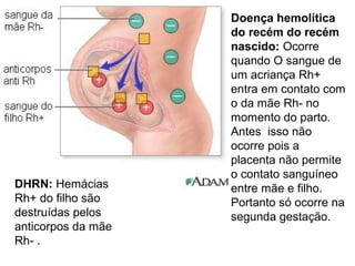 Doença hemolítica
do recém do recém
nascido: Ocorre
quando O sangue de
um acriança Rh+
entra em contato com
o da mãe Rh- no
momento do parto.
Antes isso não
ocorre pois a
placenta não permite
o contato sanguíneo
entre mãe e filho.
Portanto só ocorre na
segunda gestação.
DHRN: Hemácias
Rh+ do filho são
destruídas pelos
anticorpos da mãe
Rh- .
 