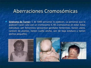 Aberraciones CromosómicasAberraciones Cromosómicas
 Síndrome de TurnerSíndrome de Turner:: 1 de 5000 personas lo padecen. La personas que lo1 de 5000 personas lo padecen. La personas que lo
padecen nacen solo con un cromosoma X /45 cromosomas en total. Estospadecen nacen solo con un cromosoma X /45 cromosomas en total. Estos
individuos son femeninos (presentan genitales femeninos, tienen utero,individuos son femeninos (presentan genitales femeninos, tienen utero,
carecen de ovarios, tienen cuello ancho, son de baja estatura y tienencarecen de ovarios, tienen cuello ancho, son de baja estatura y tienen
pechos pequeñospechos pequeños
 