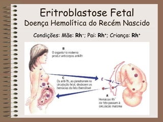 Eritroblastose Fetal
Doença Hemolítica do Recém Nascido
Condições: Mãe: Rh-; Pai: Rh+; Criança: Rh+
 
