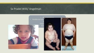 Sx Pradel Willi/ Angelman
Pradel Willi (SPW)
 Paterno
 Hipotinía
 Retraso del desarrollo infantil
 Hiperfagia
Angelman (SA)
 Materno
 Retraso mental severo
 Convulsiones
 Ataques de ira
 Carencia de lenguaje
• Neurogenéticos
• Perdida de función de genes improntados de
forma opuesta
15q11-q13 (7 Genes)
• Delecion de 4 genes
 