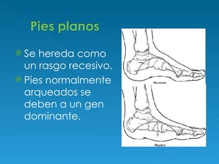 Se hereda como un rasgo recesivo.  Pies normalmente arqueados se deben a un gen dominante . 