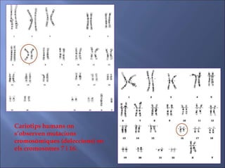 Cariotips humans on
s’observen mutacions
cromosòmiques (deleccions) en
els cromosomes 7 i 16.
 