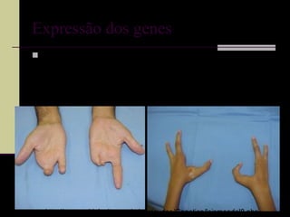 Expressão dos genes
 Expressividade - É a capacidade que tem um gene
de revelar a sua expressão com maior ou menor
intensidade.
OBS: Dois indivíduos podem ter o mesmo genótipo e
apresentarem fenótipos diferentes.
http://www.sobiologia.com.br/conteudos/Genetica/leismendel8.php
 