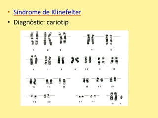 • Síndrome de Klinefelter
• Diagnòstic: cariotip
 