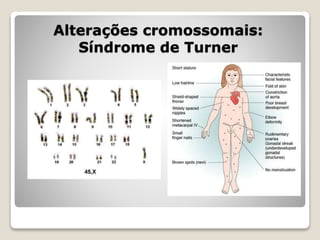 Alterações cromossomais:
Síndrome de Turner
 