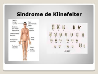 Sindrome de Klinefelter
 