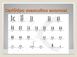 Cariótipo masculino anormal
Cariótipo masculino anormal
 