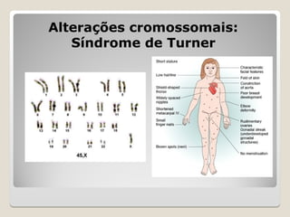 Alterações cromossomais:
Alterações cromossomais:
Síndrome de Turner
Síndrome de Turner
 