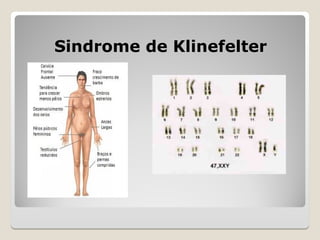 Sindrome de Klinefelter
Sindrome de Klinefelter
 