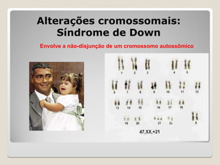 Alterações cromossomais:
Alterações cromossomais:
Síndrome de Down
Síndrome de Down
Envolve a não-disjunção de um cromossomo autossômico
 