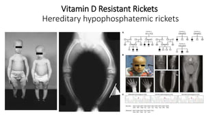 Genetic Basis & Clinical Features of Achondroplasia [Autosaved].pptx